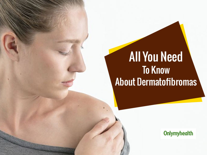 Visible Bumps On The Skin? These Bumps Can Be Dermatofibromas, Says Dr Dadu
